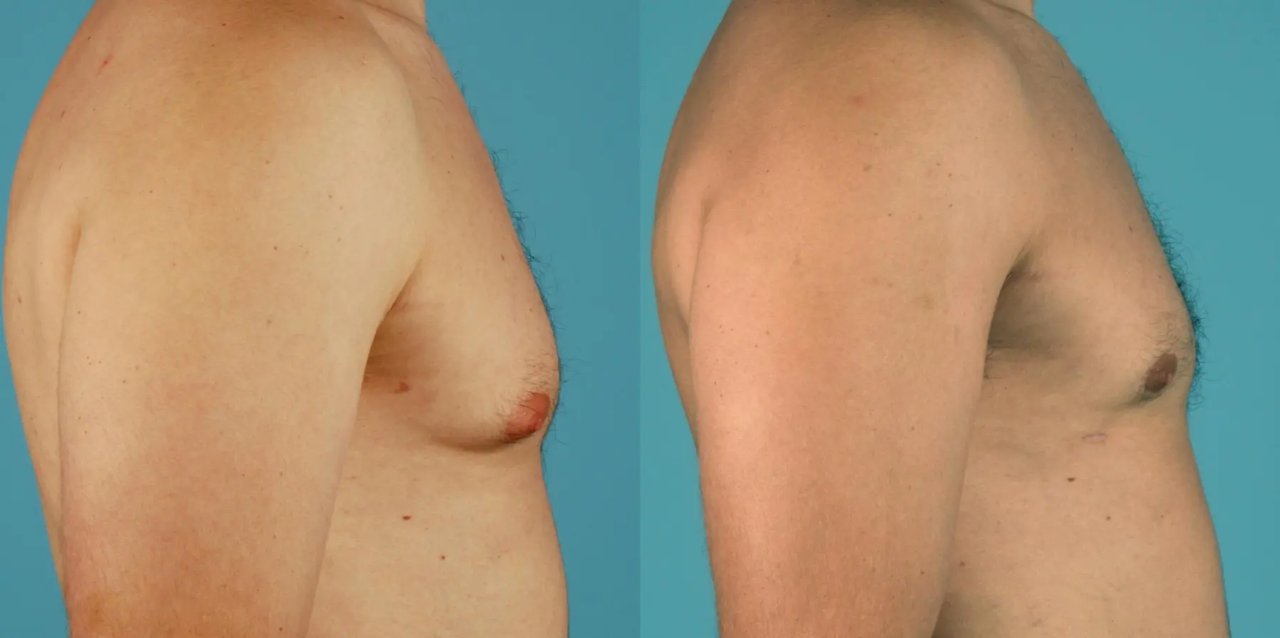 Male Breast Reduction: Patient 13 - Before and After 3
