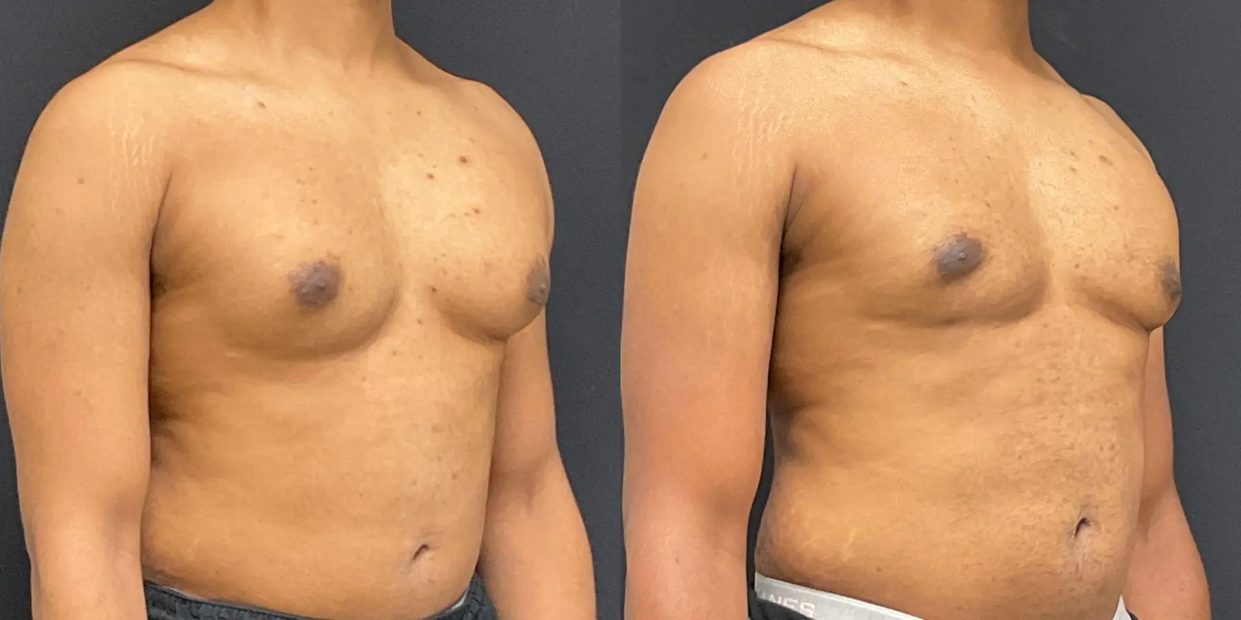 Male Breast Reduction: Patient 8 - Before and After 3