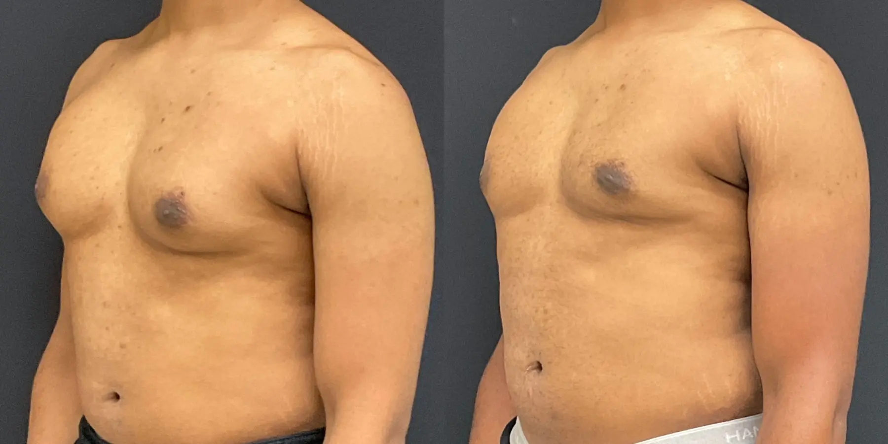 Male Breast Reduction: Patient 8 - Before and After 2