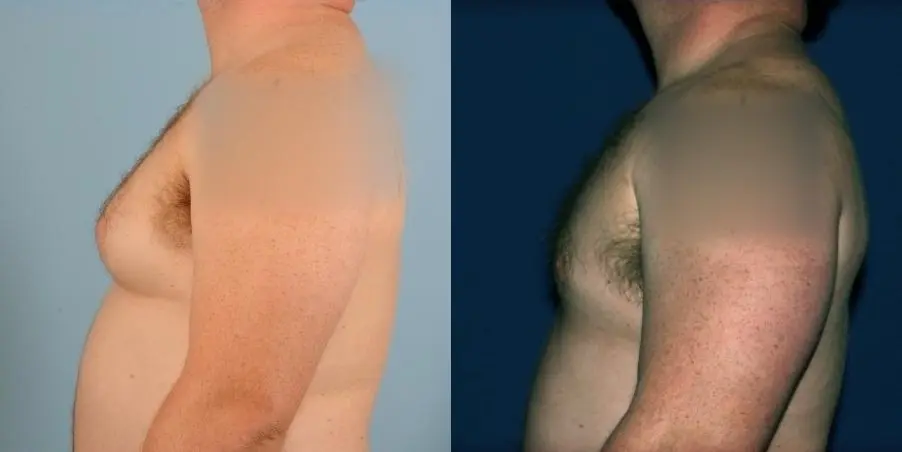 Male Breast Reduction: Patient 11 - Before and After 1