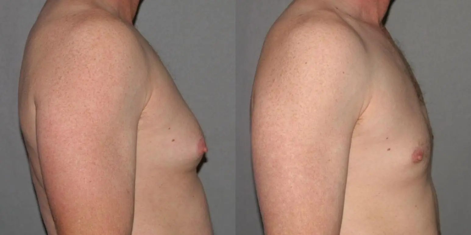Male Breast Reduction: Patient 9 - Before and After 3
