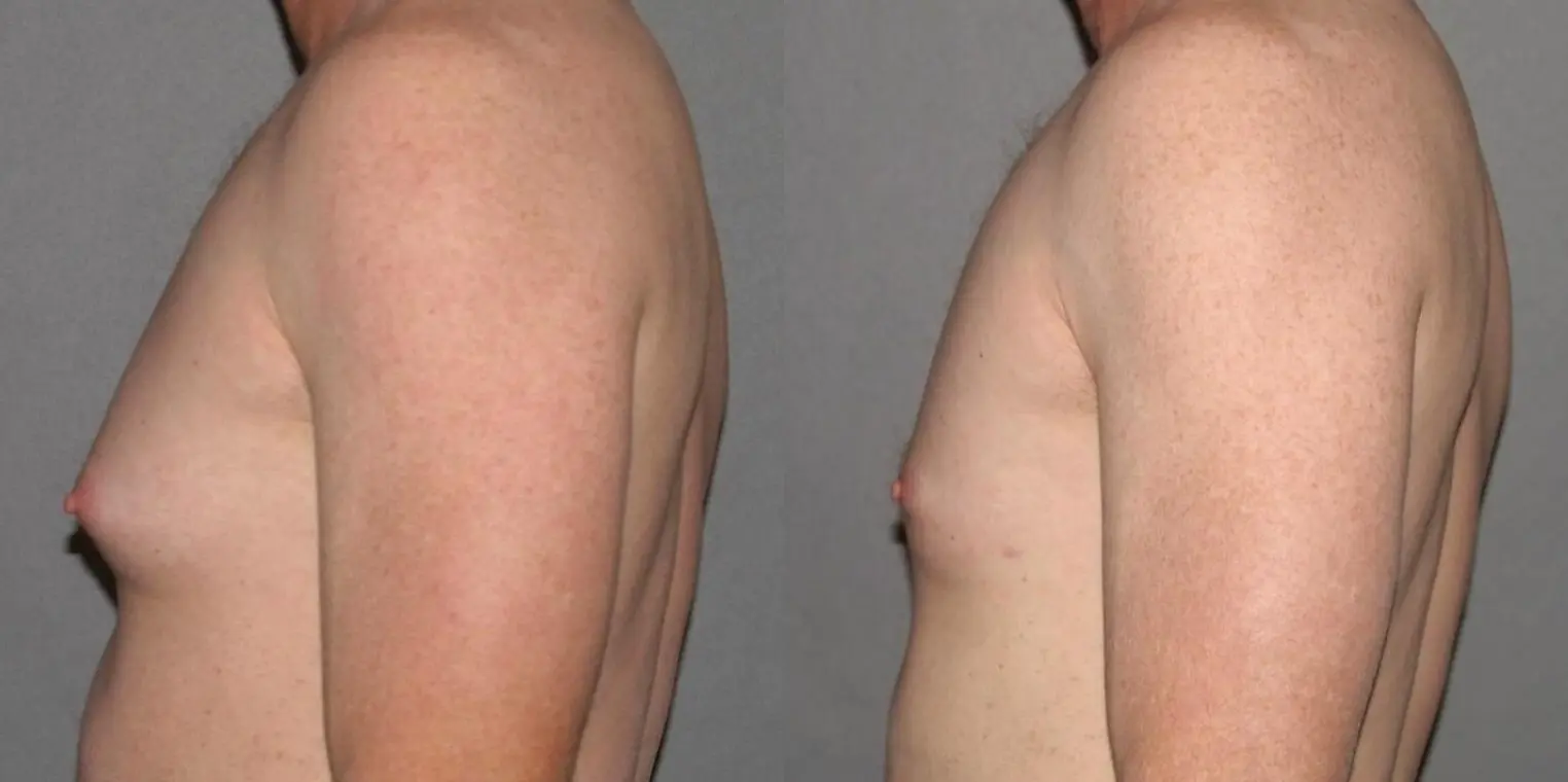 Male Breast Reduction: Patient 9 - Before and After 2
