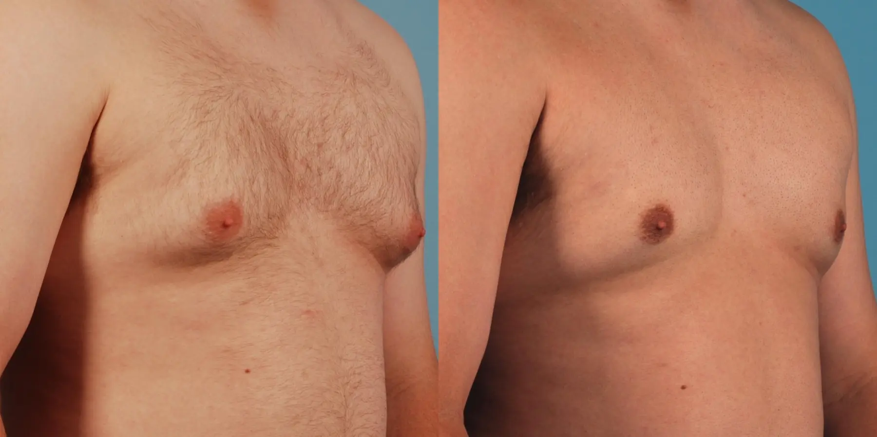 Male Breast Reduction: Patient 12 - Before and After 3