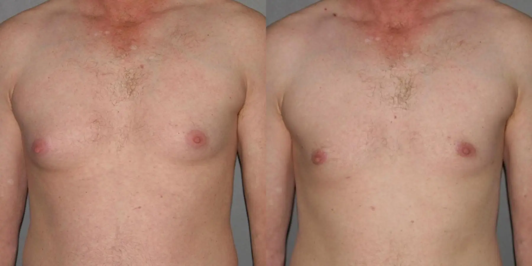 Male Breast Reduction: Patient 9 - Before and After 1