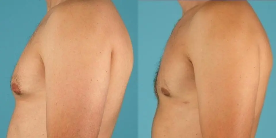 Male Breast Reduction: Patient 13 - Before and After 2