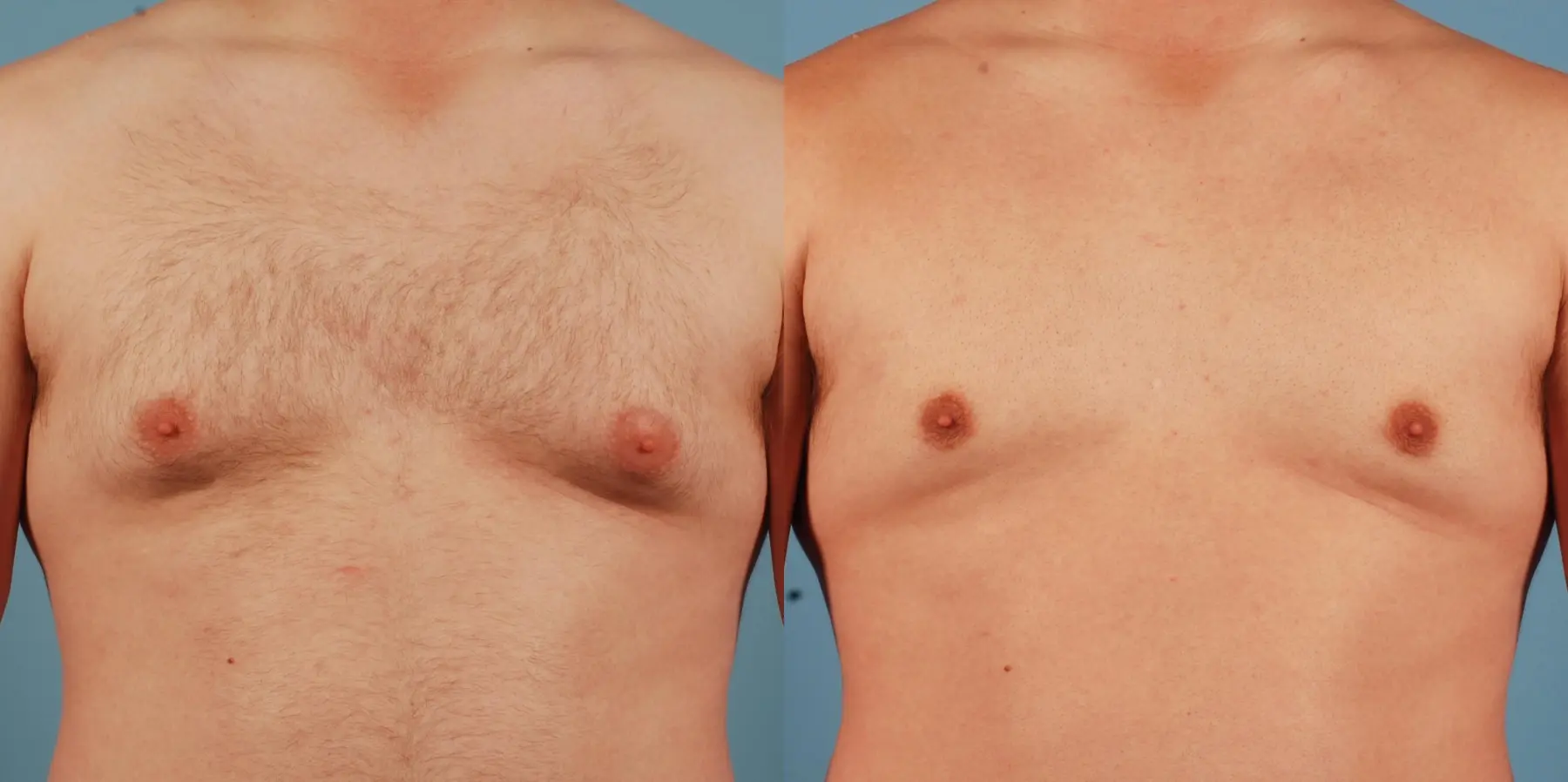 Male Breast Reduction: Patient 12 - Before and After 1