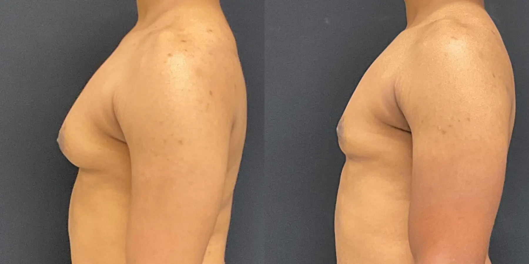 Male Breast Reduction: Patient 8 - Before and After 4