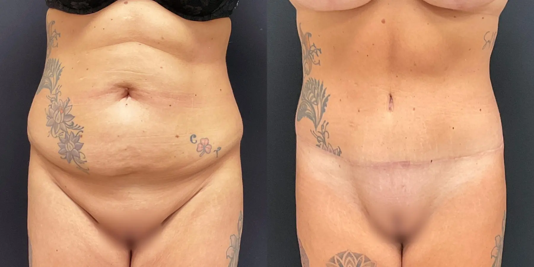 Mommy Makeover: Patient 10 - Before and After  