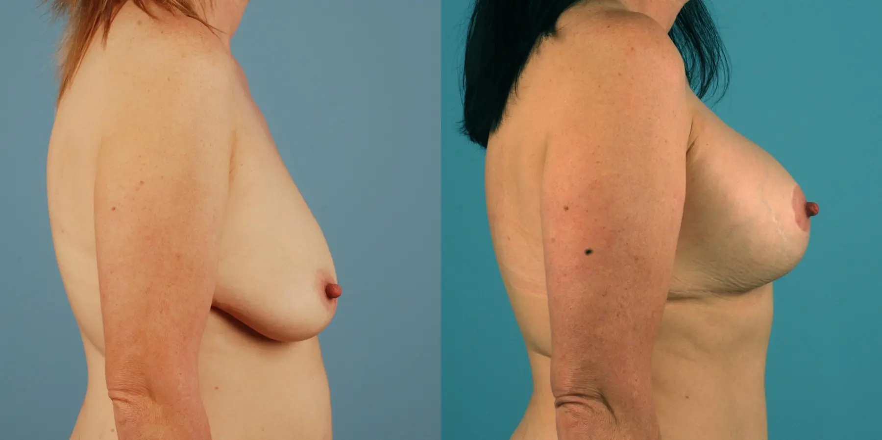 Mommy Makeover: Patient 12 - Before and After 4