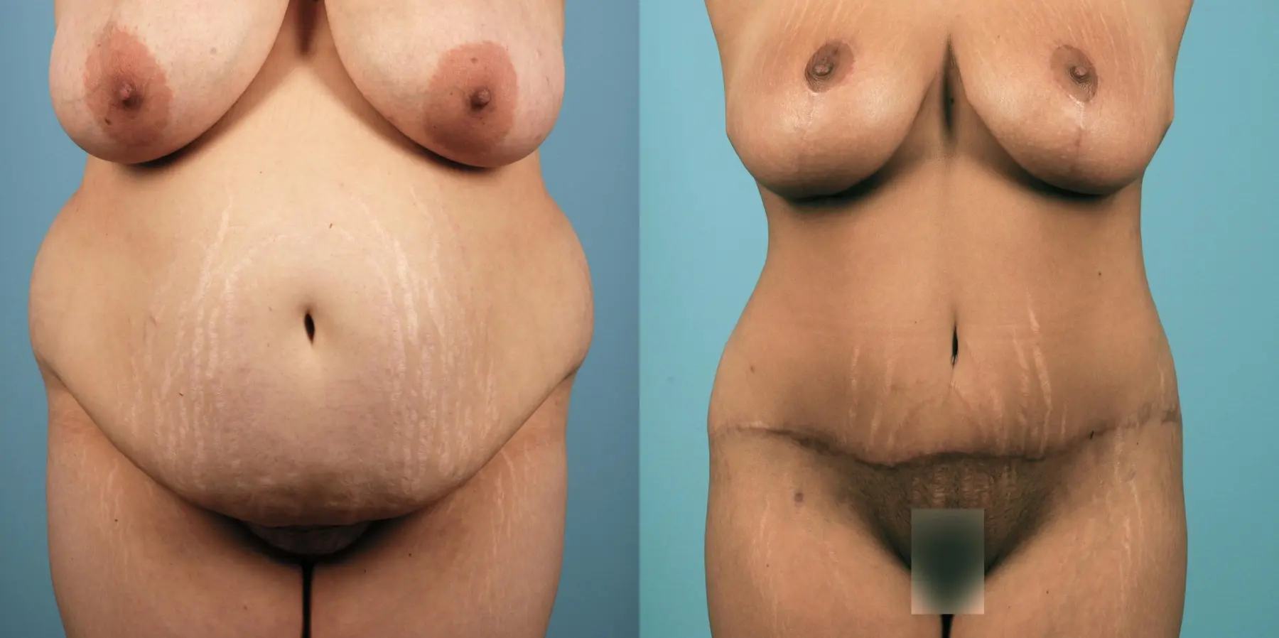 Mommy Makeover: Patient 9 - Before and After  