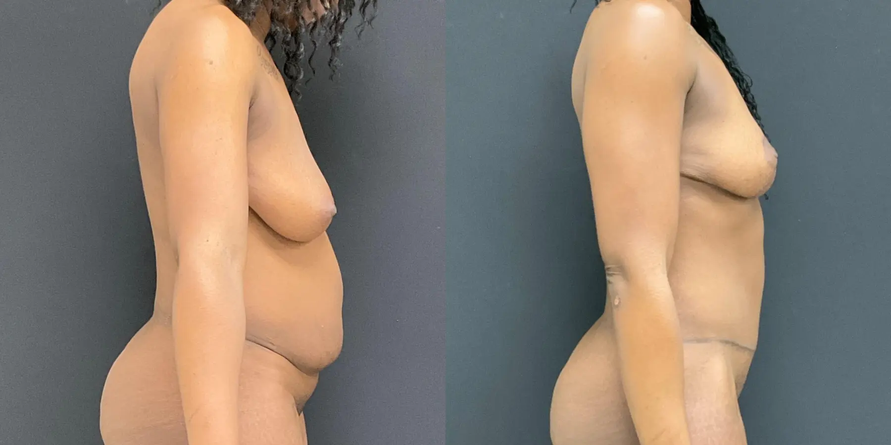 Mommy Makeover: Patient 15 - Before and After 5