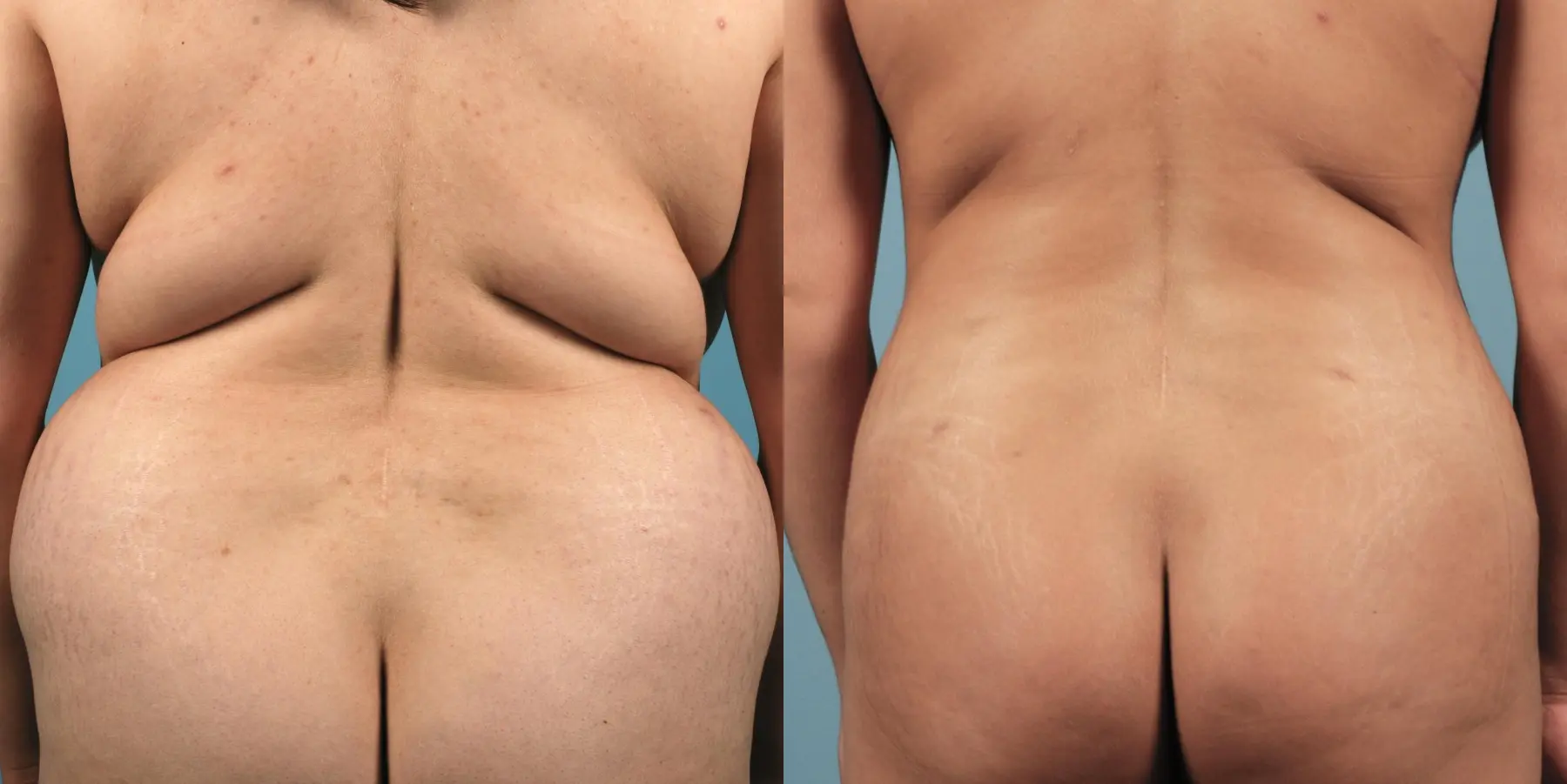 Mommy Makeover: Patient 9 - Before and After 4