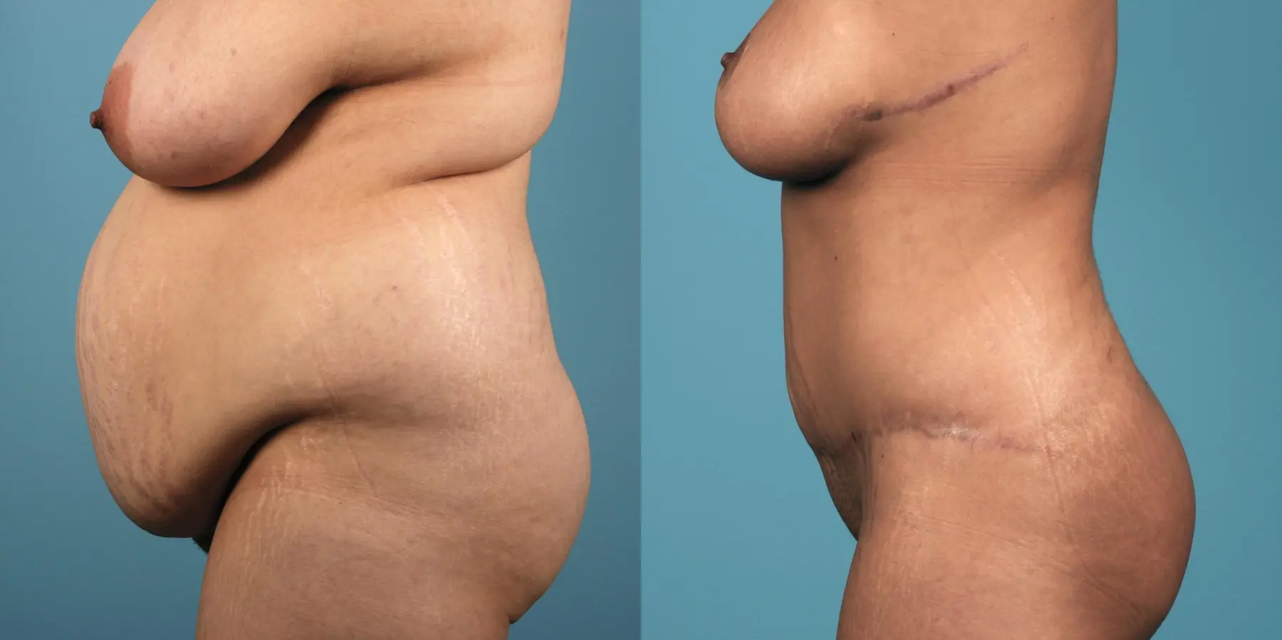 Mommy Makeover: Patient 9 - Before and After 3