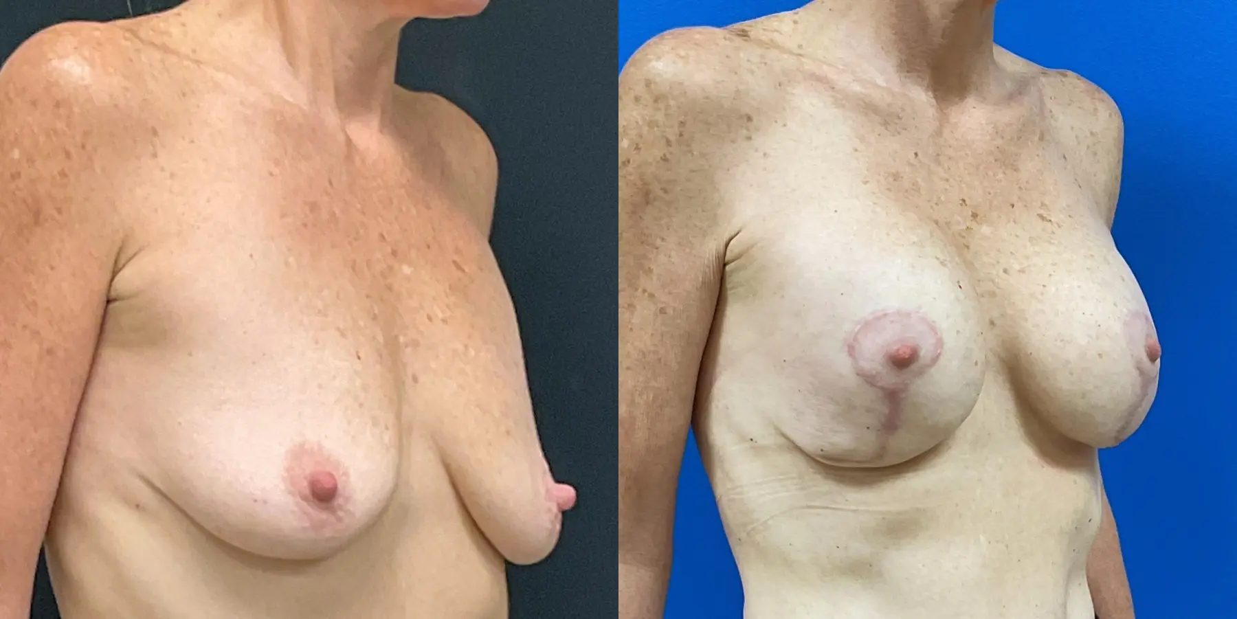 Mommy Makeover: Patient 14 - Before and After 3