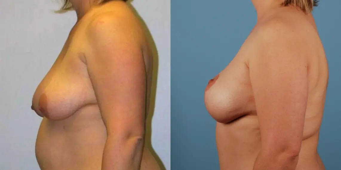 Mommy Makeover: Patient 8 - Before and After 3