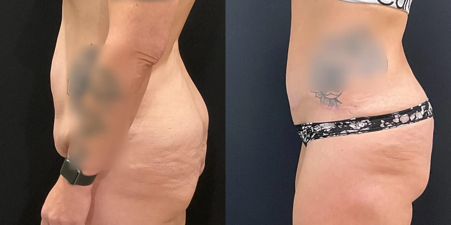 Mommy Makeover: Patient 13 - Before and After 4