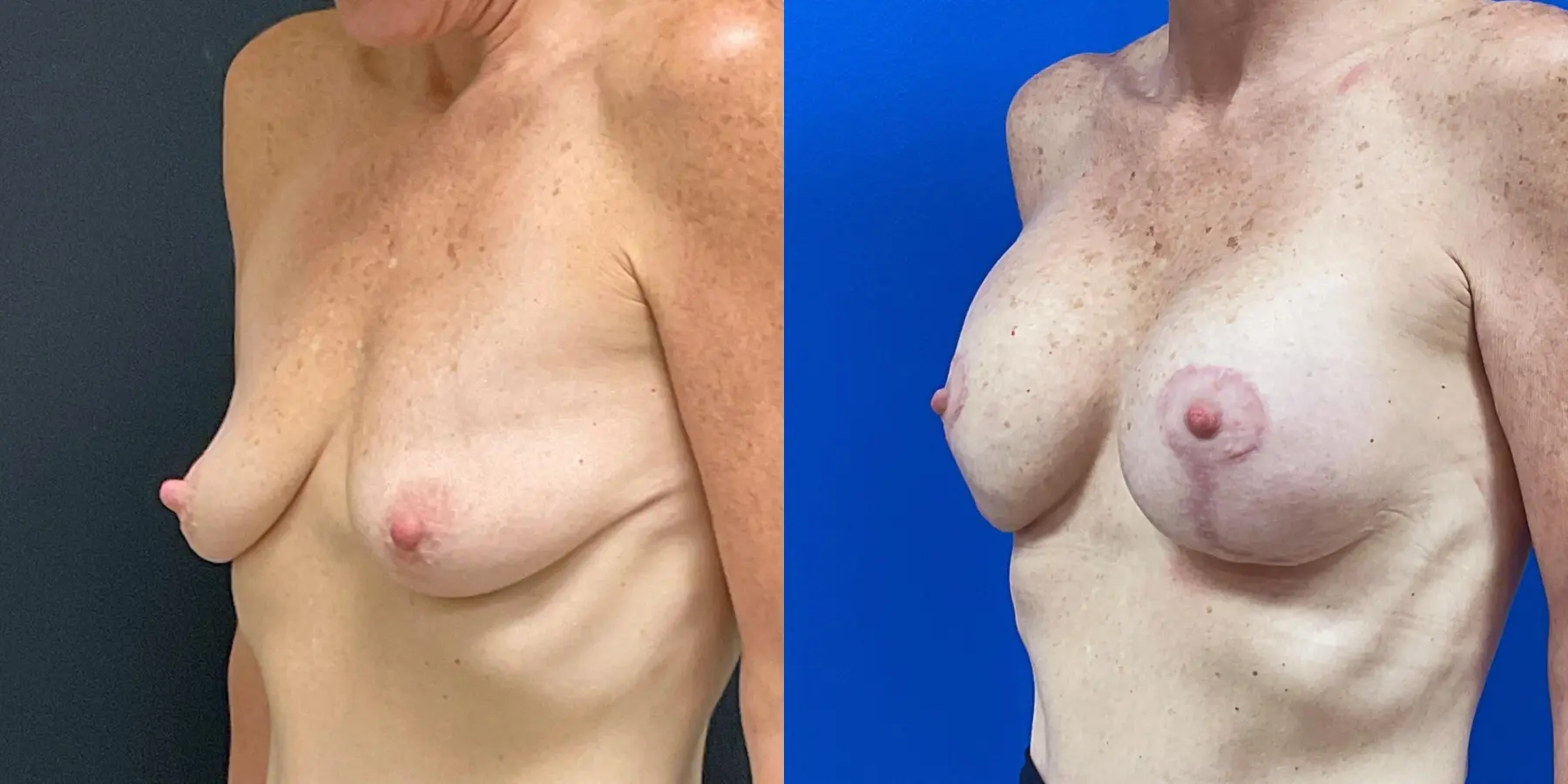Mommy Makeover: Patient 14 - Before and After 2