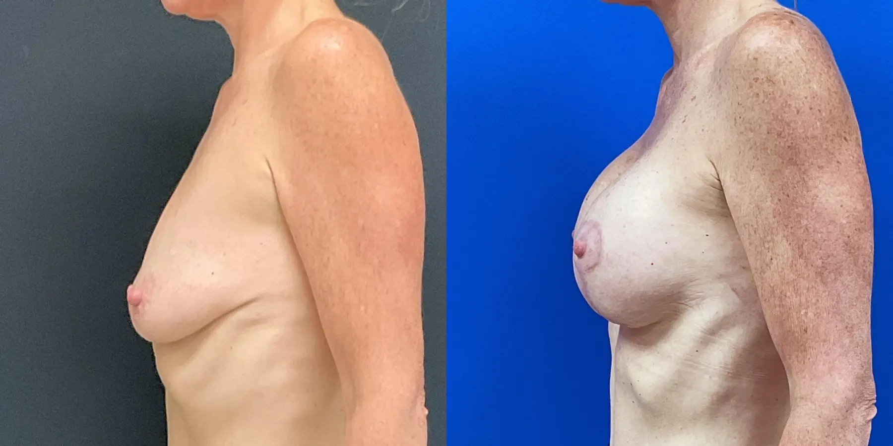 Mommy Makeover: Patient 14 - Before and After 4