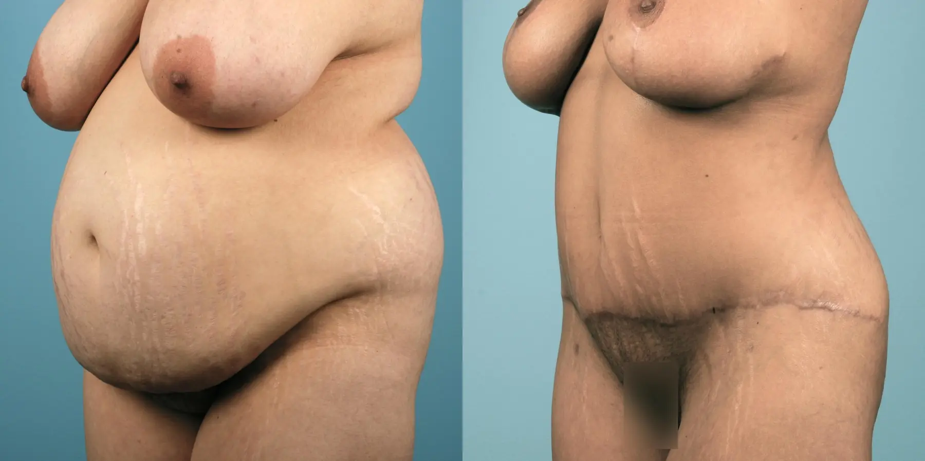 Mommy Makeover: Patient 9 - Before and After 2