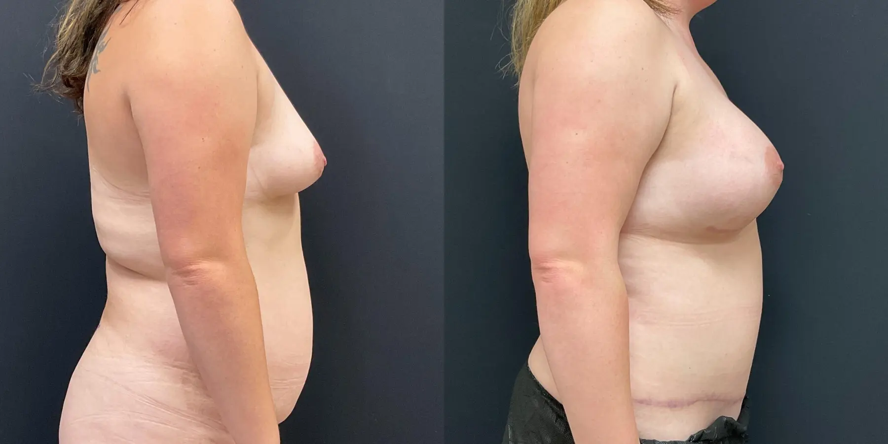 Mommy Makeover: Patient 11 - Before and After 5