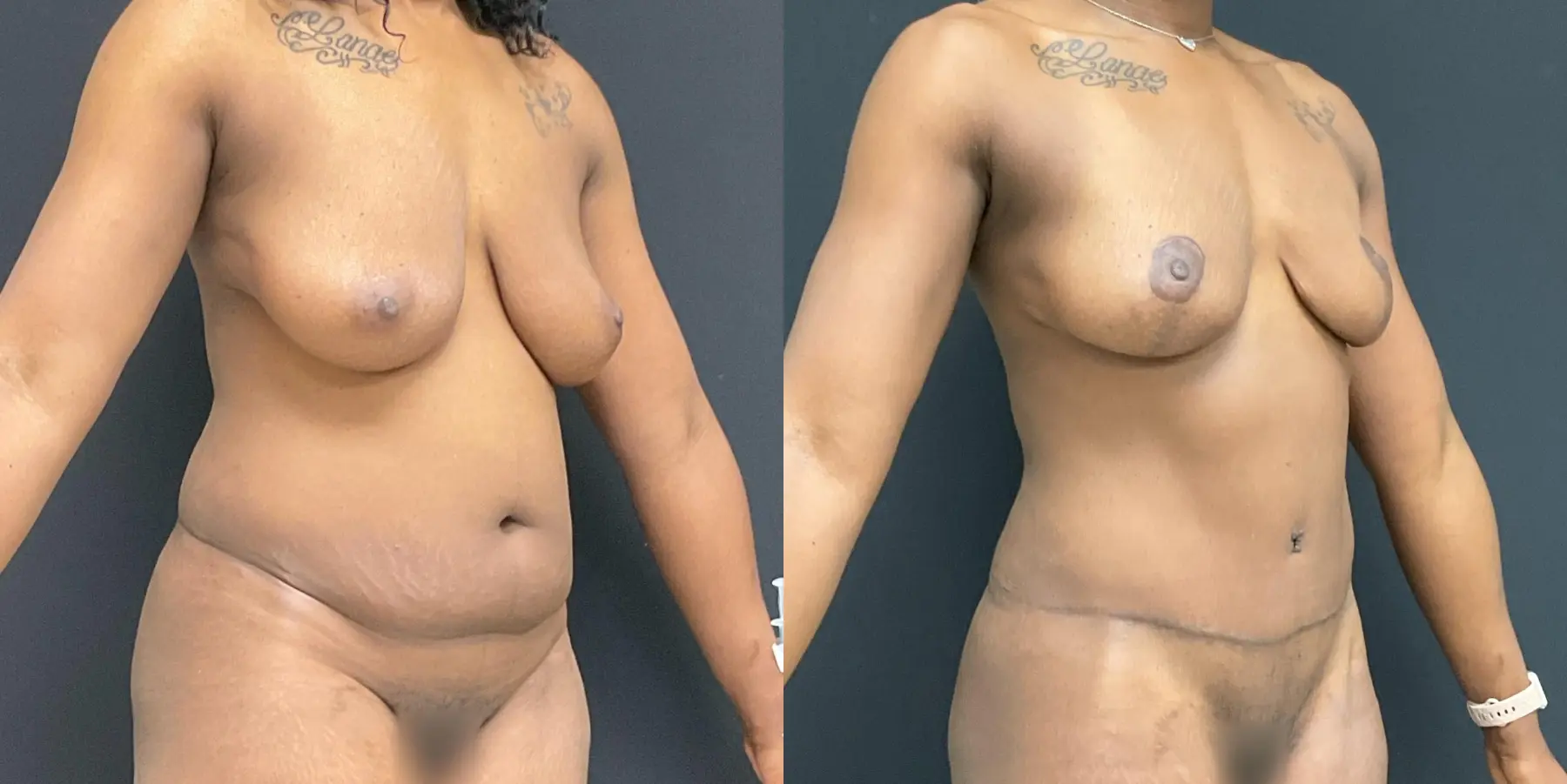 Mommy Makeover: Patient 15 - Before and After 3