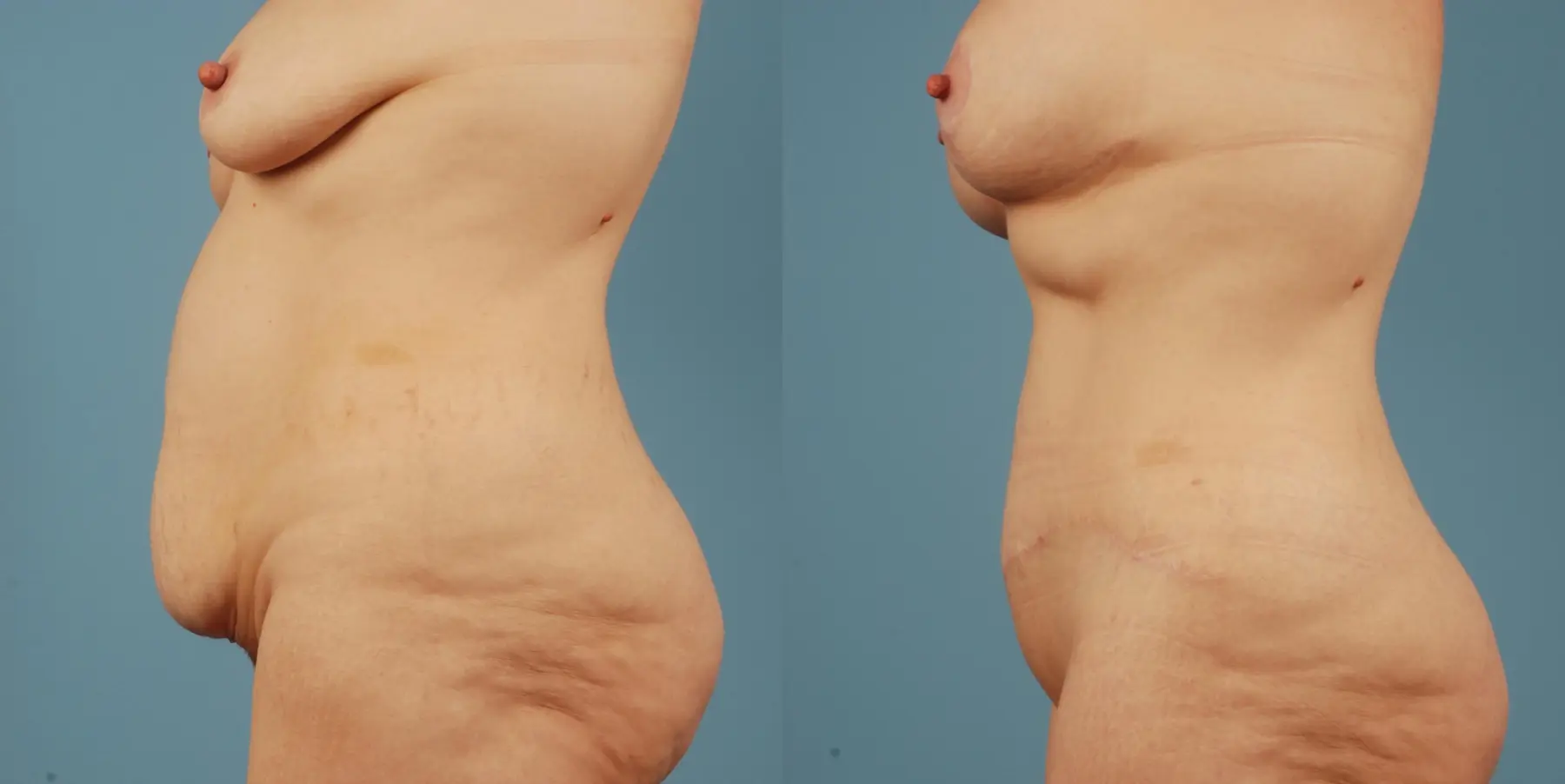 Mommy Makeover: Patient 12 - Before and After 2