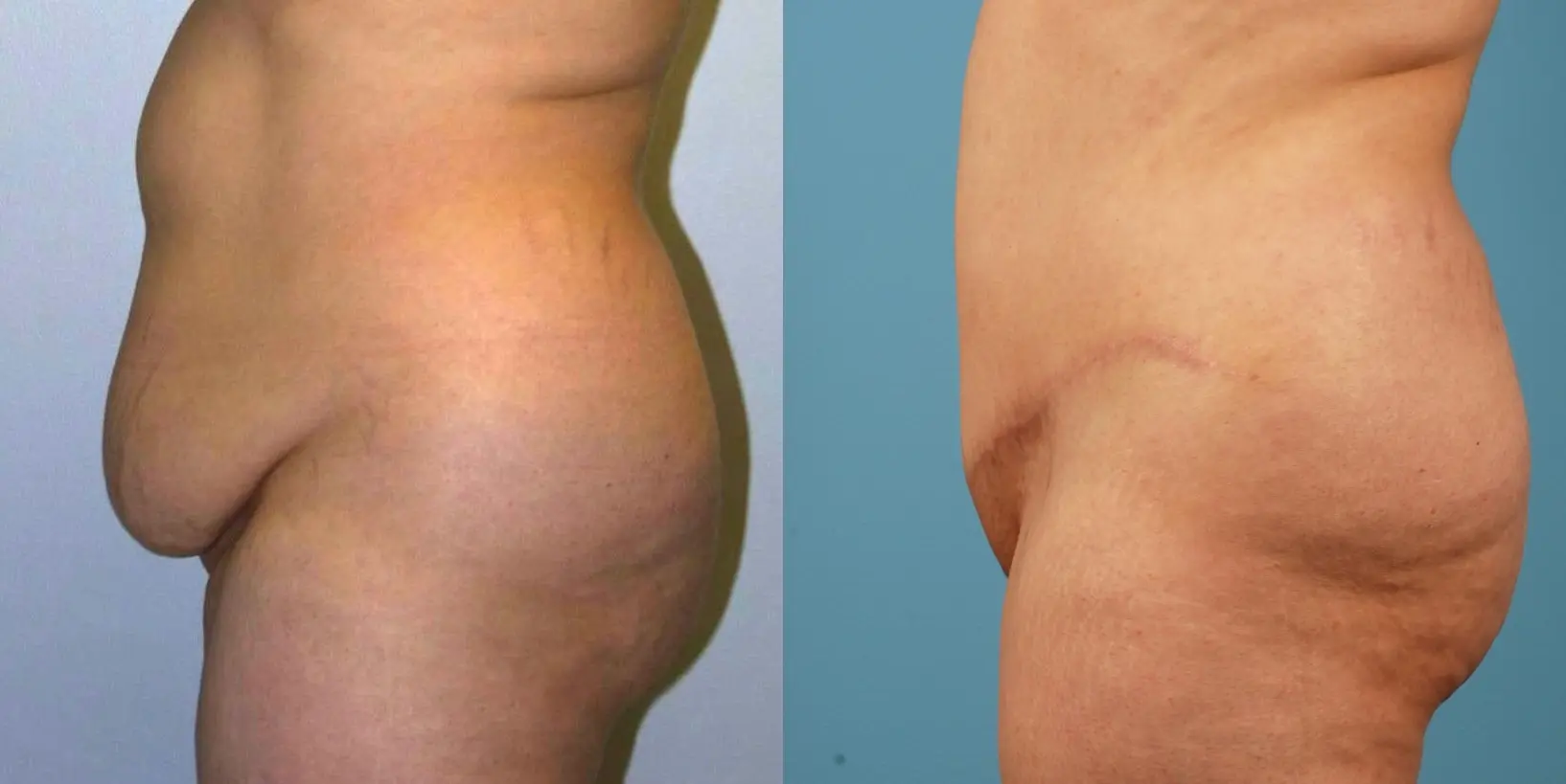 Mommy Makeover: Patient 8 - Before and After 6