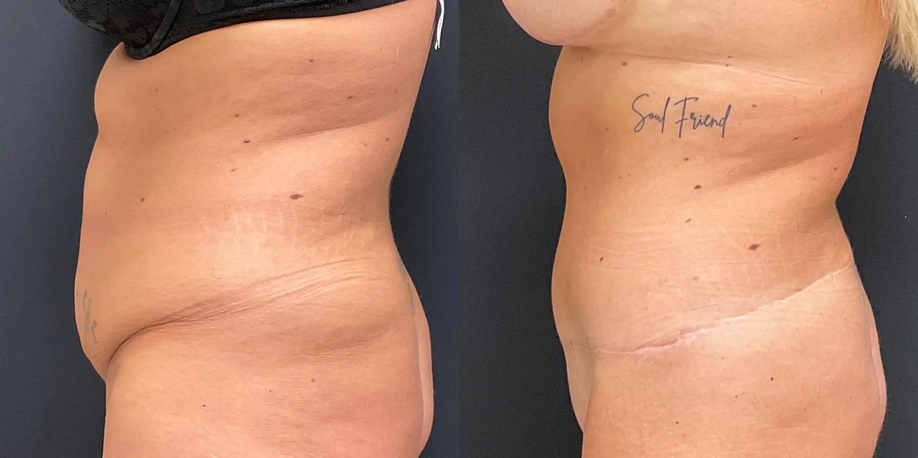 Mommy Makeover: Patient 10 - Before and After 4