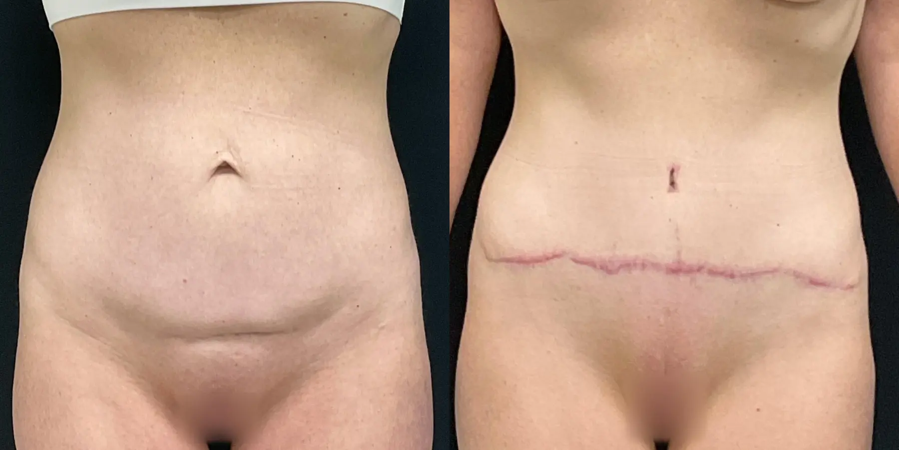 Mommy Makeover: Patient 14 - Before and After 6
