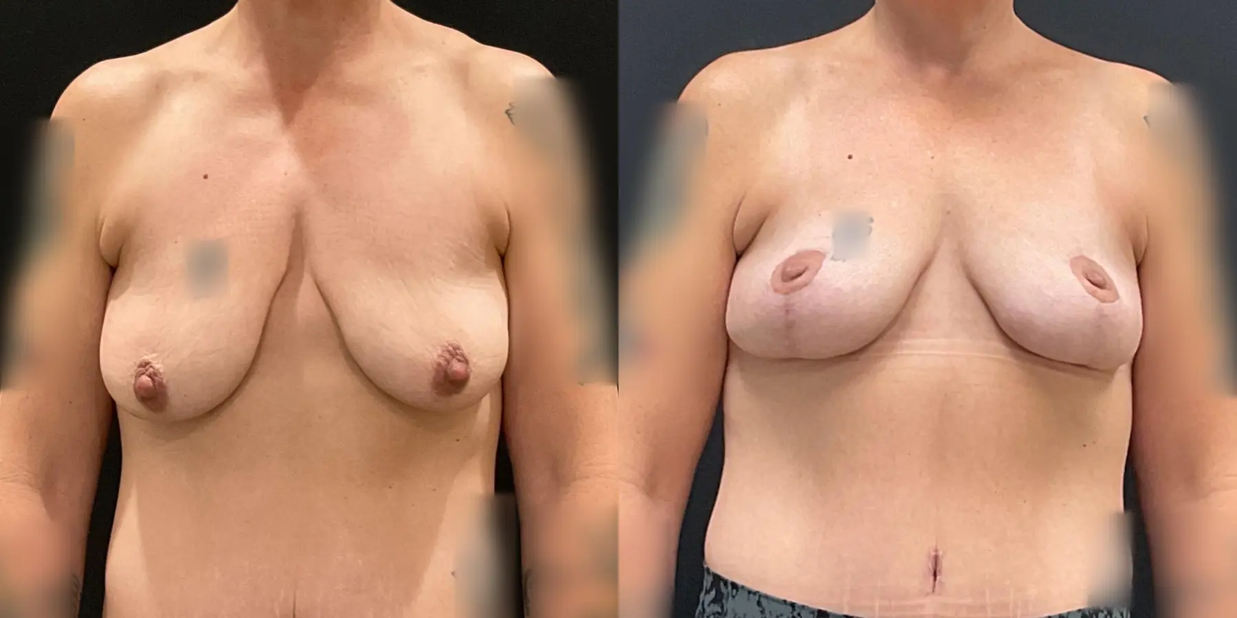 Mommy Makeover: Patient 13 - Before and After 6