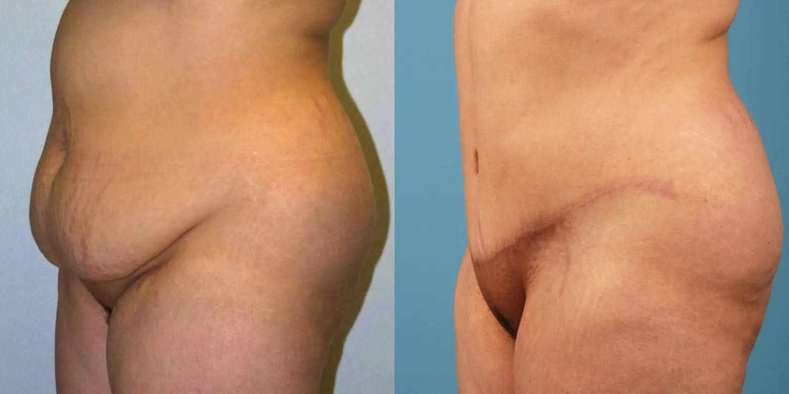Mommy Makeover: Patient 8 - Before and After 5