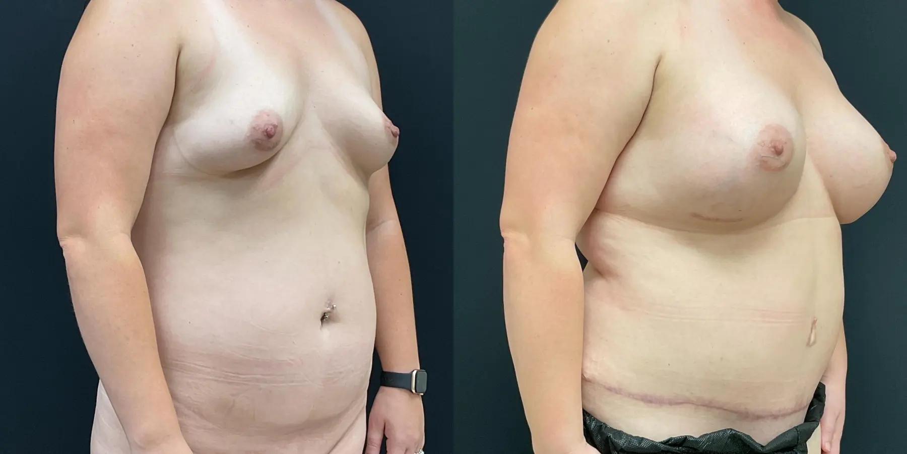 Mommy Makeover: Patient 11 - Before and After 3
