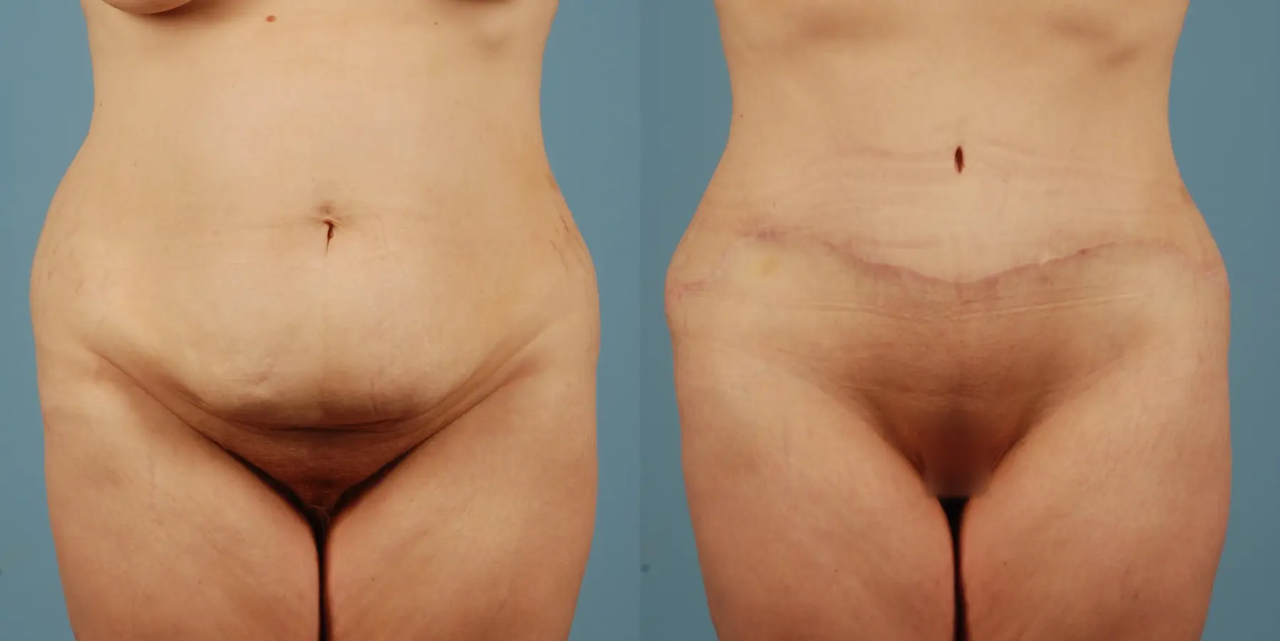 Mommy Makeover: Patient 12 - Before and After 5