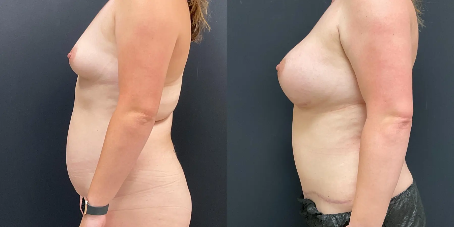 Mommy Makeover: Patient 11 - Before and After 4
