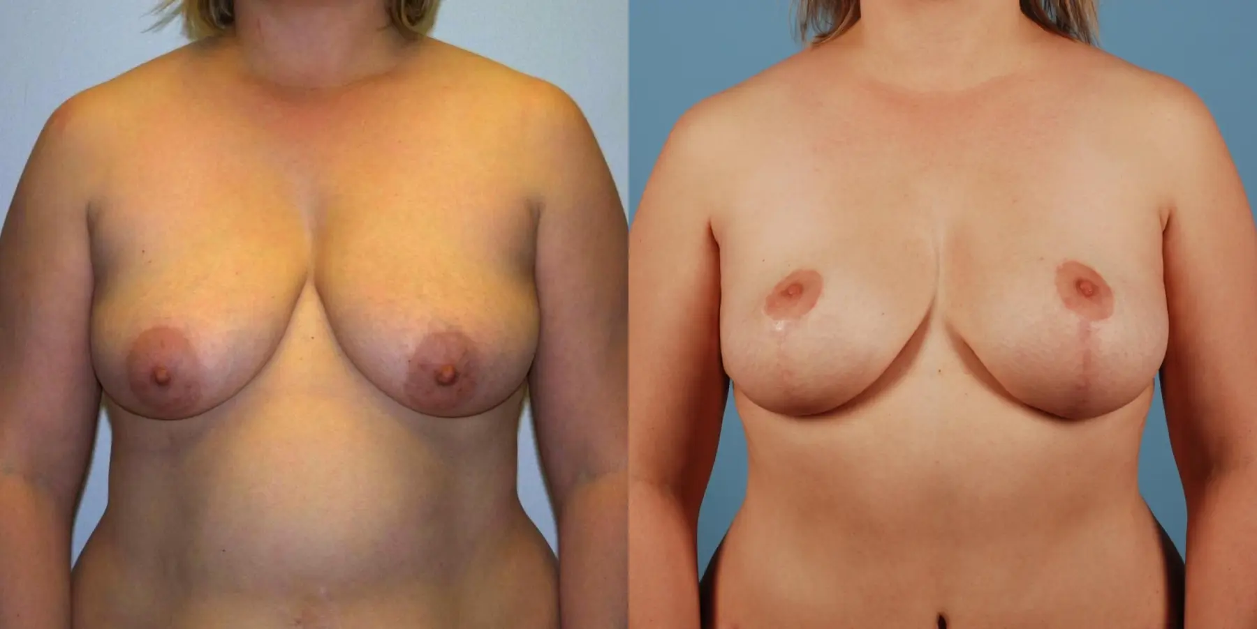 Mommy Makeover: Patient 8 - Before and After  