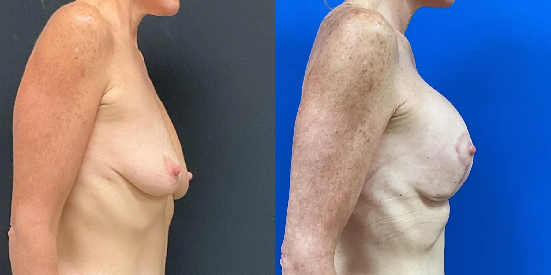 Mommy Makeover: Patient 14 - Before and After 5