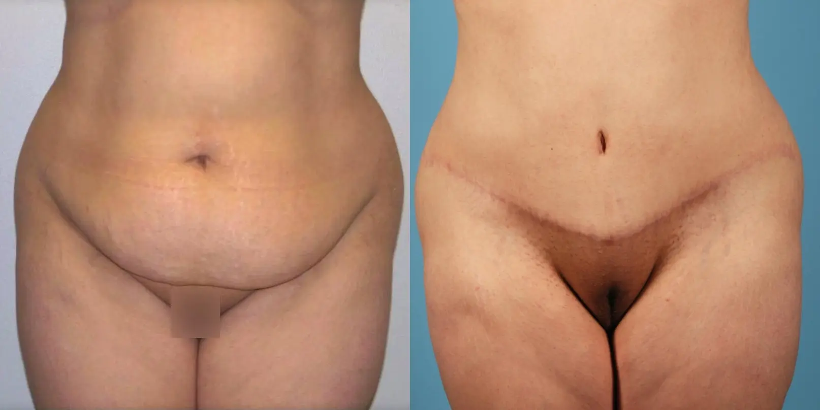 Mommy Makeover: Patient 8 - Before and After 4