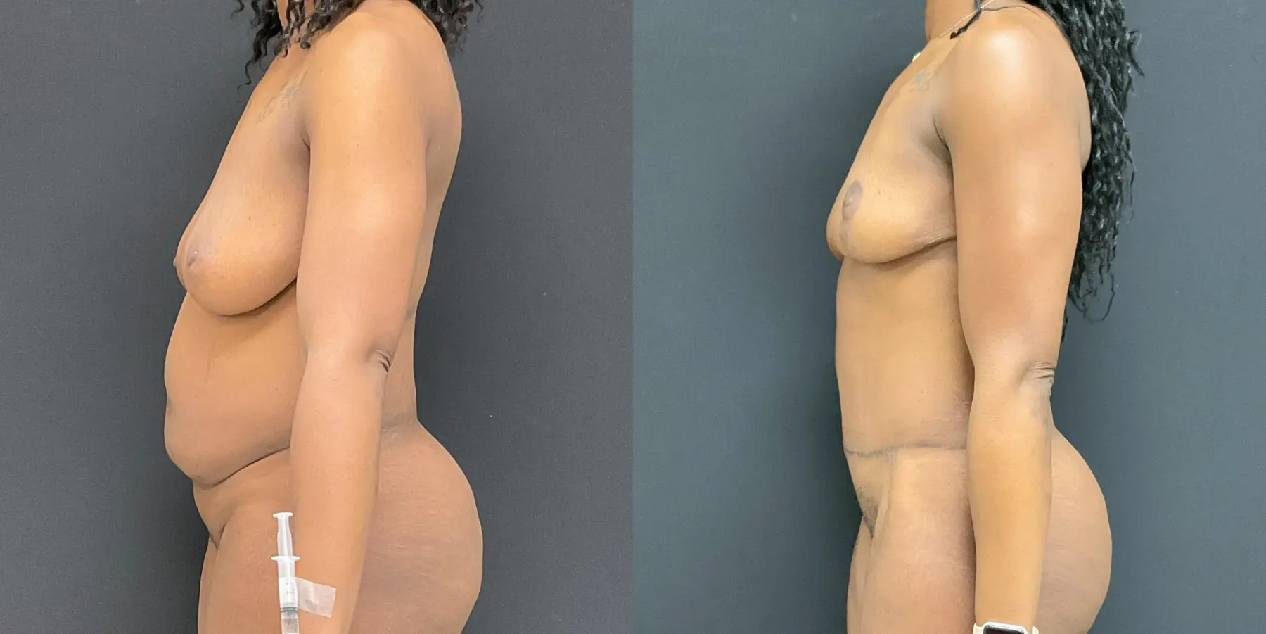 Mommy Makeover: Patient 15 - Before and After 4