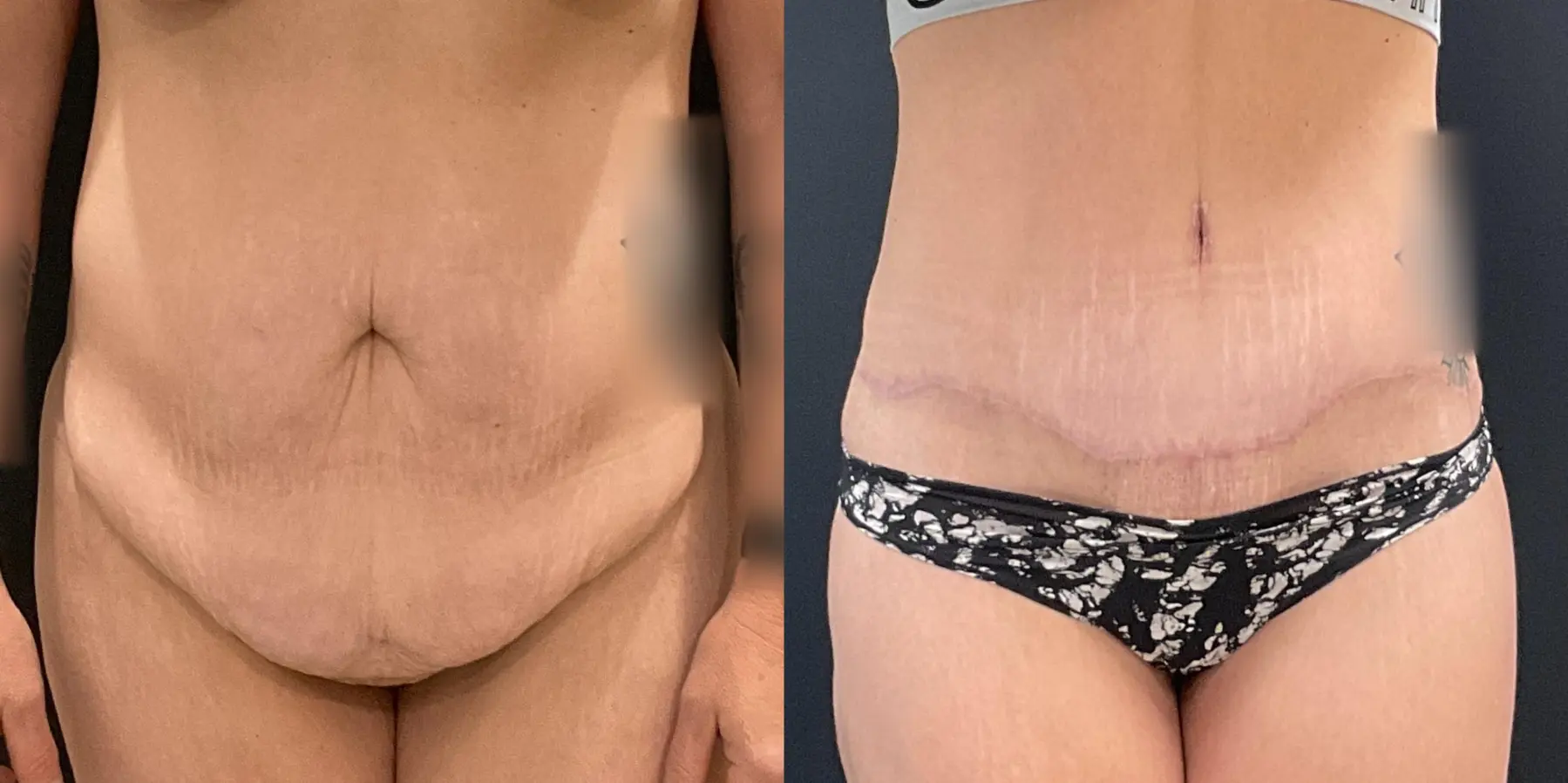 Mommy Makeover: Patient 13 - Before and After 1