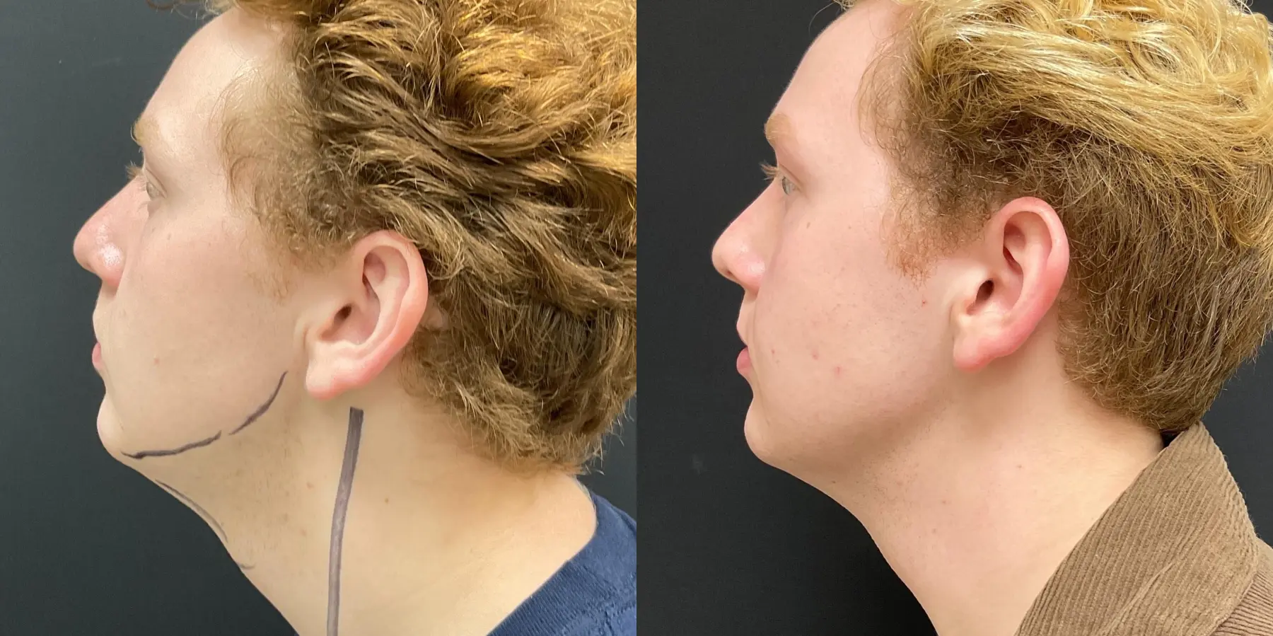 Morpheus8 For Men: Patient 1 - Before and After 5