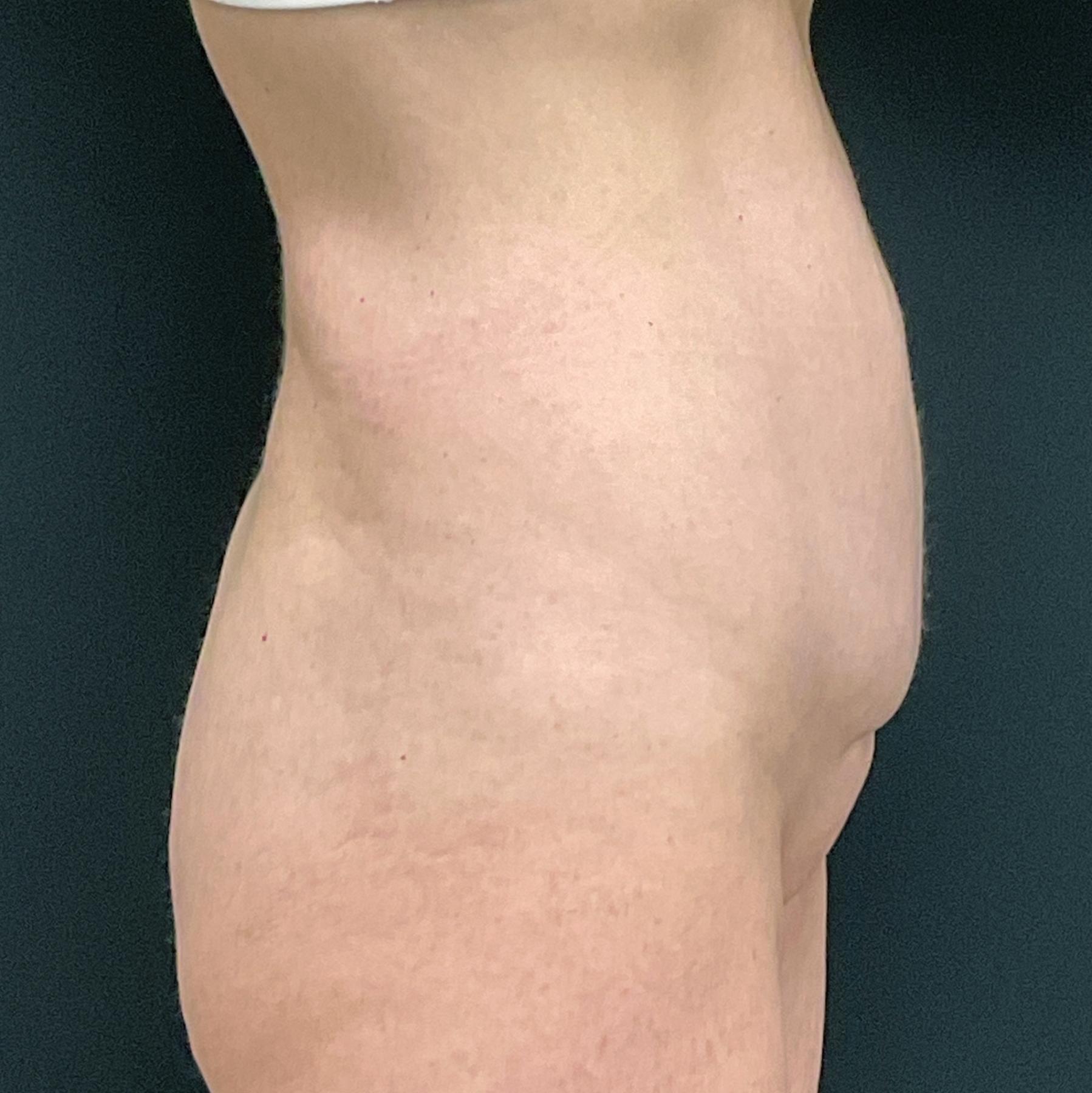 Mommy Makeover: Patient 14 - Before and After 10