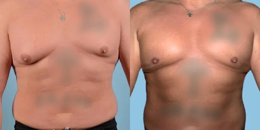 Skin-tightening-for-men: Patient 9 - Before and After  