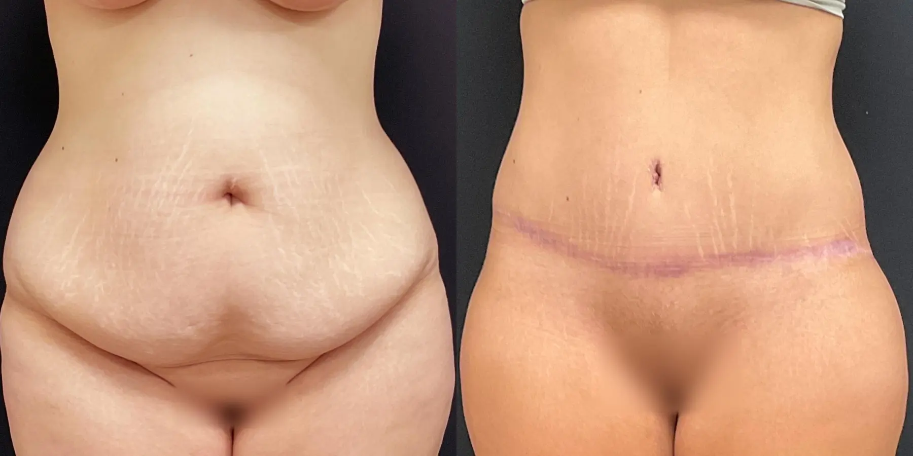 Tummy Tuck: Patient 17 - Before and After 1