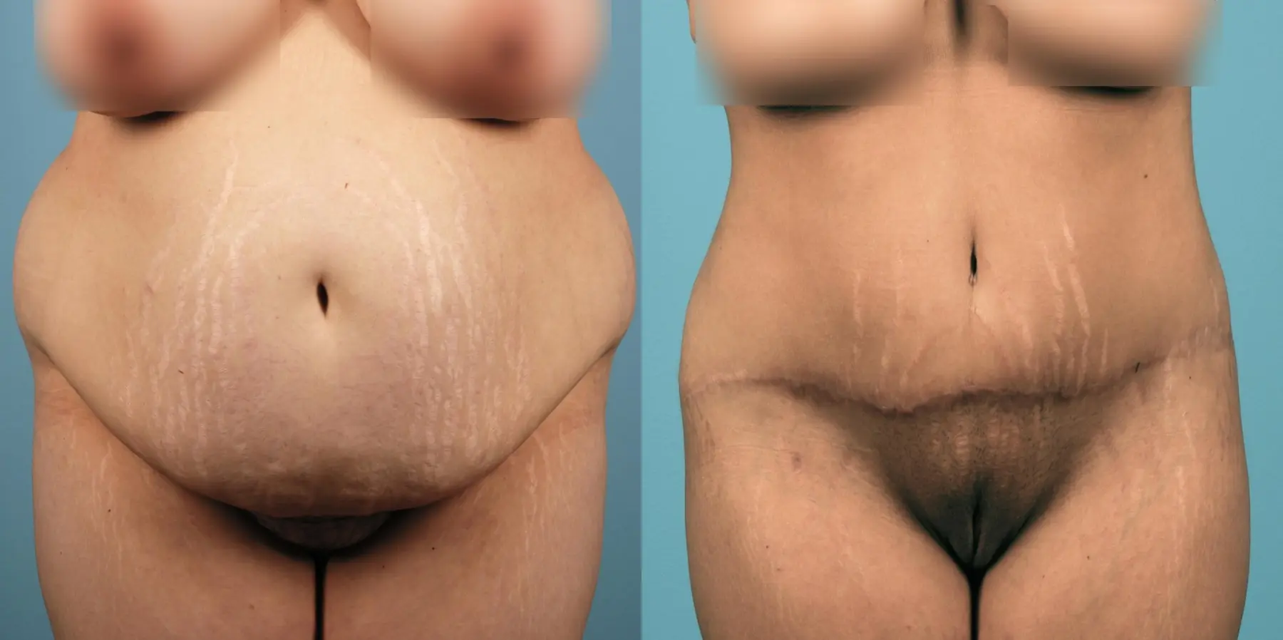 Tummy Tuck: Patient 10 - Before and After  