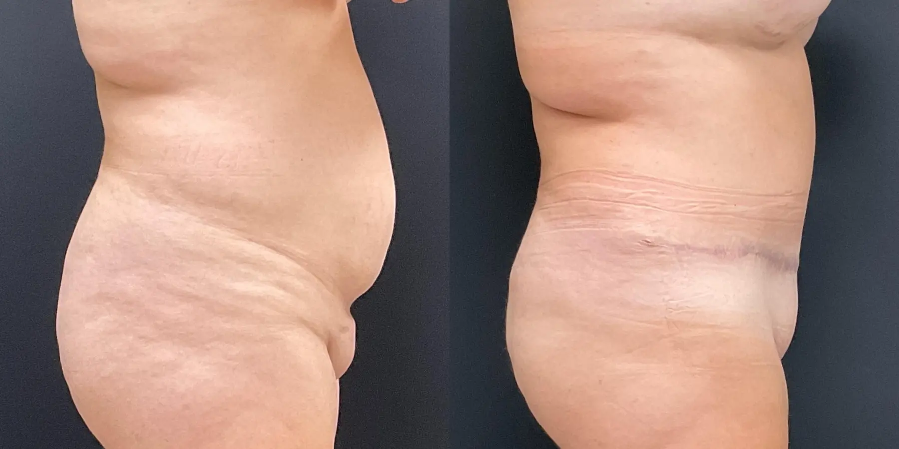 Tummy Tuck: Patient 22 - Before and After 5