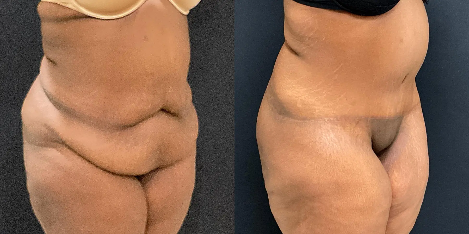 Tummy Tuck: Patient 18 - Before and After 2