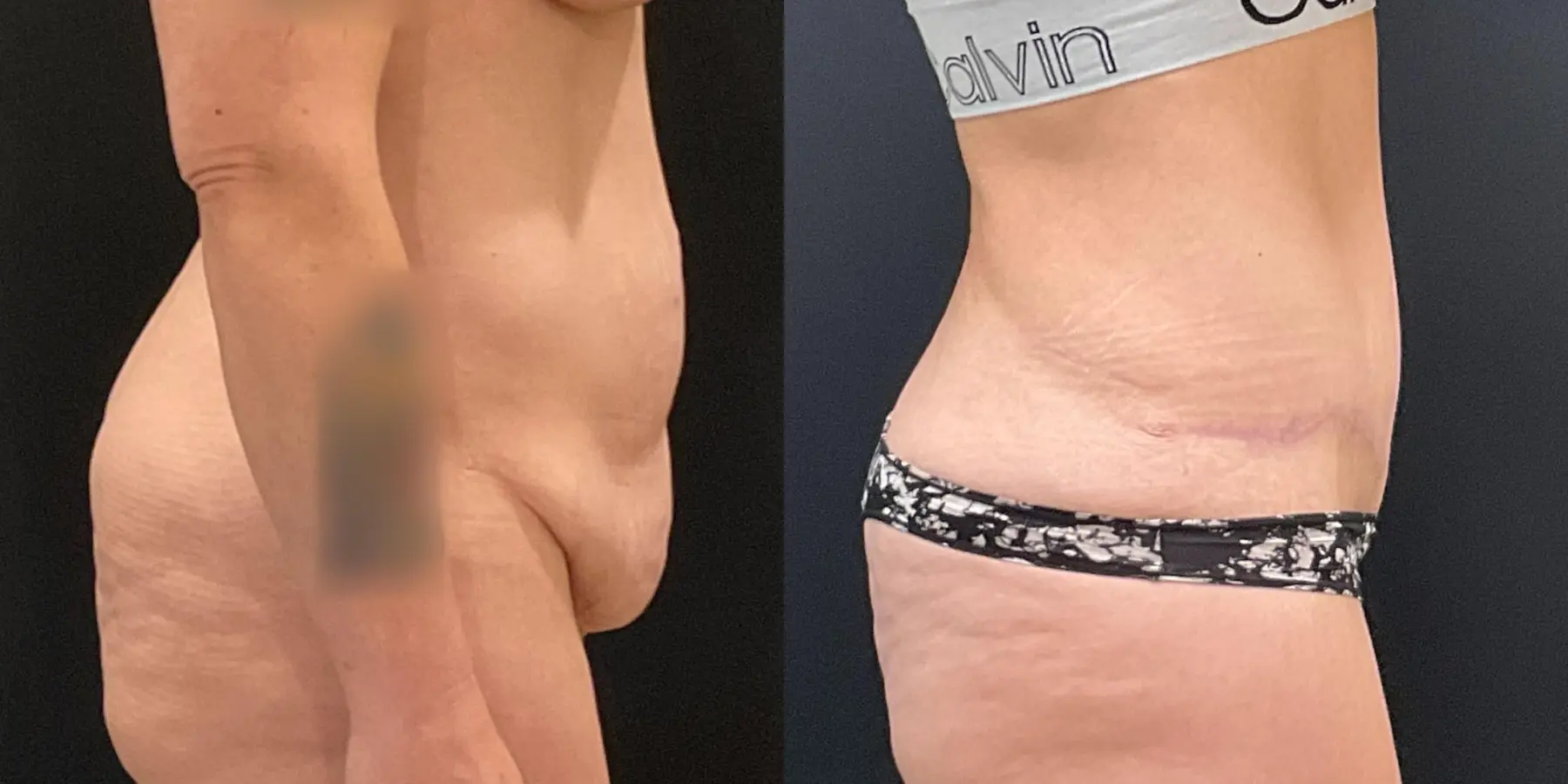 Tummy Tuck: Patient 21 - Before and After 5