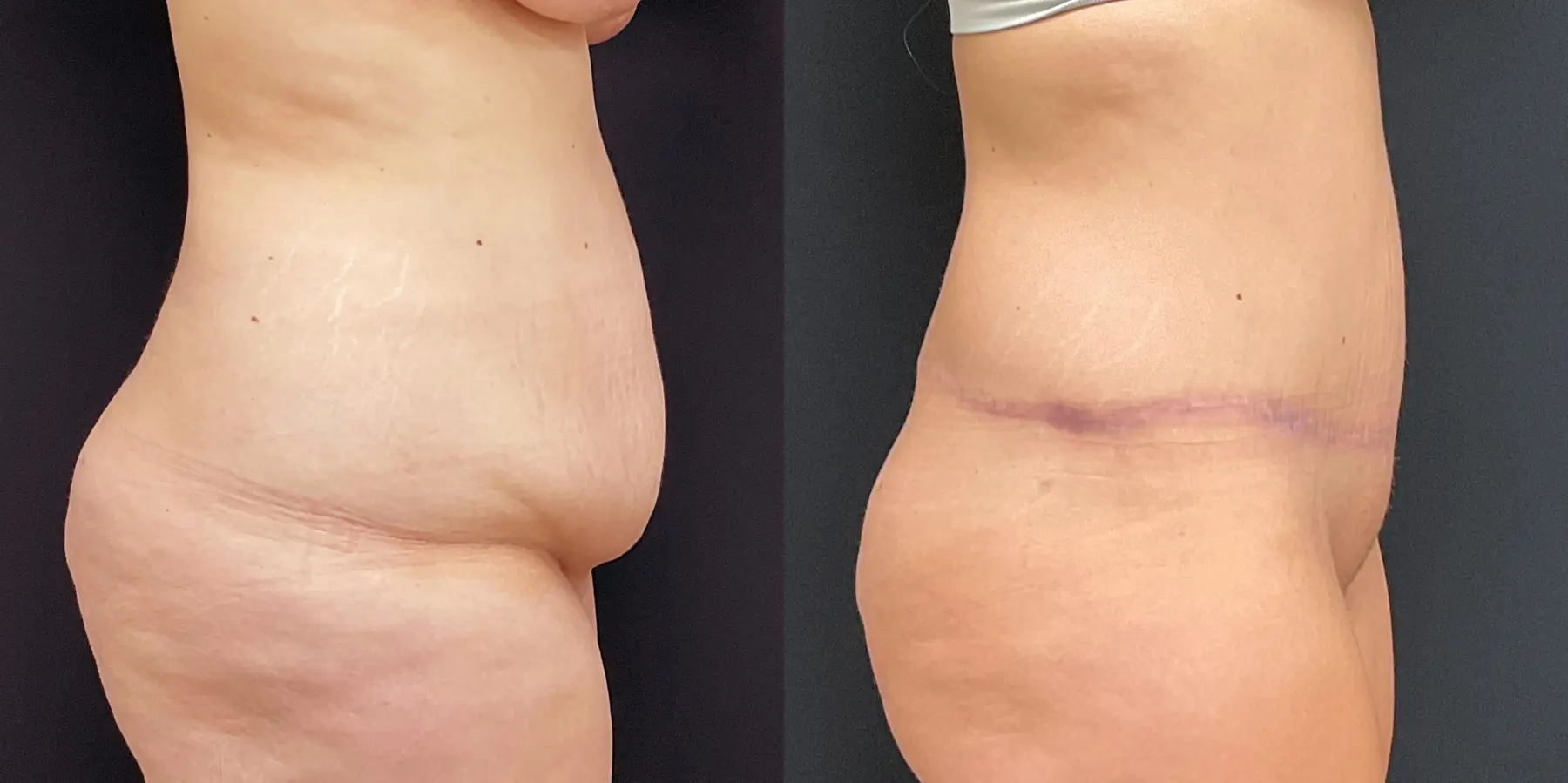 Tummy Tuck: Patient 17 - Before and After 5