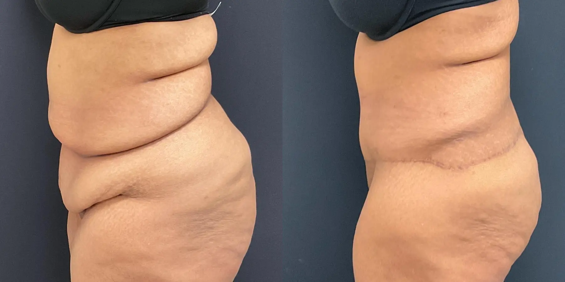 Tummy Tuck: Patient 16 - Before and After 4