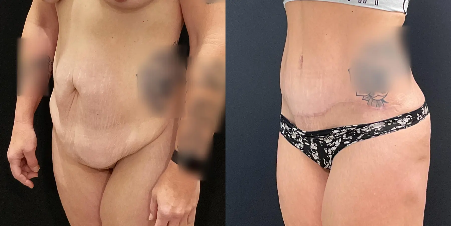 Tummy Tuck: Patient 21 - Before and After 2